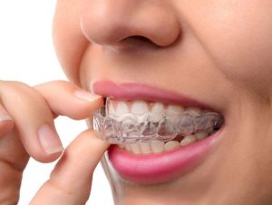 Woman removing clear aligners